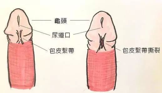 包皮系带过短的诊断与治疗