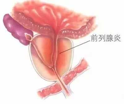 【医说】前列腺炎患者最关注的八个问题。深入浅出带你了解前列腺!