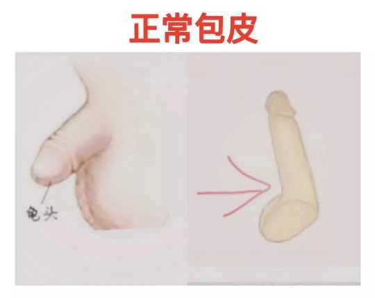 【医说】保护好小鸟:勿把“蹼状阴茎”“隐匿型阴茎”误认为简单的“包茎或包皮过长”