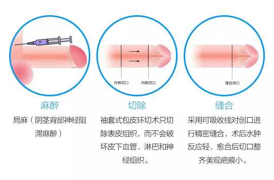 包皮二次整形与袖套式,这种术后外观像艺术品!