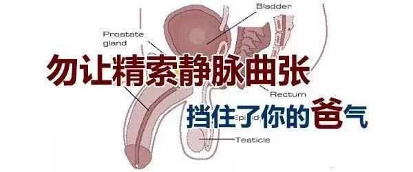 10个男人1个有精索静脉曲张,可能导致不育!如何预防?