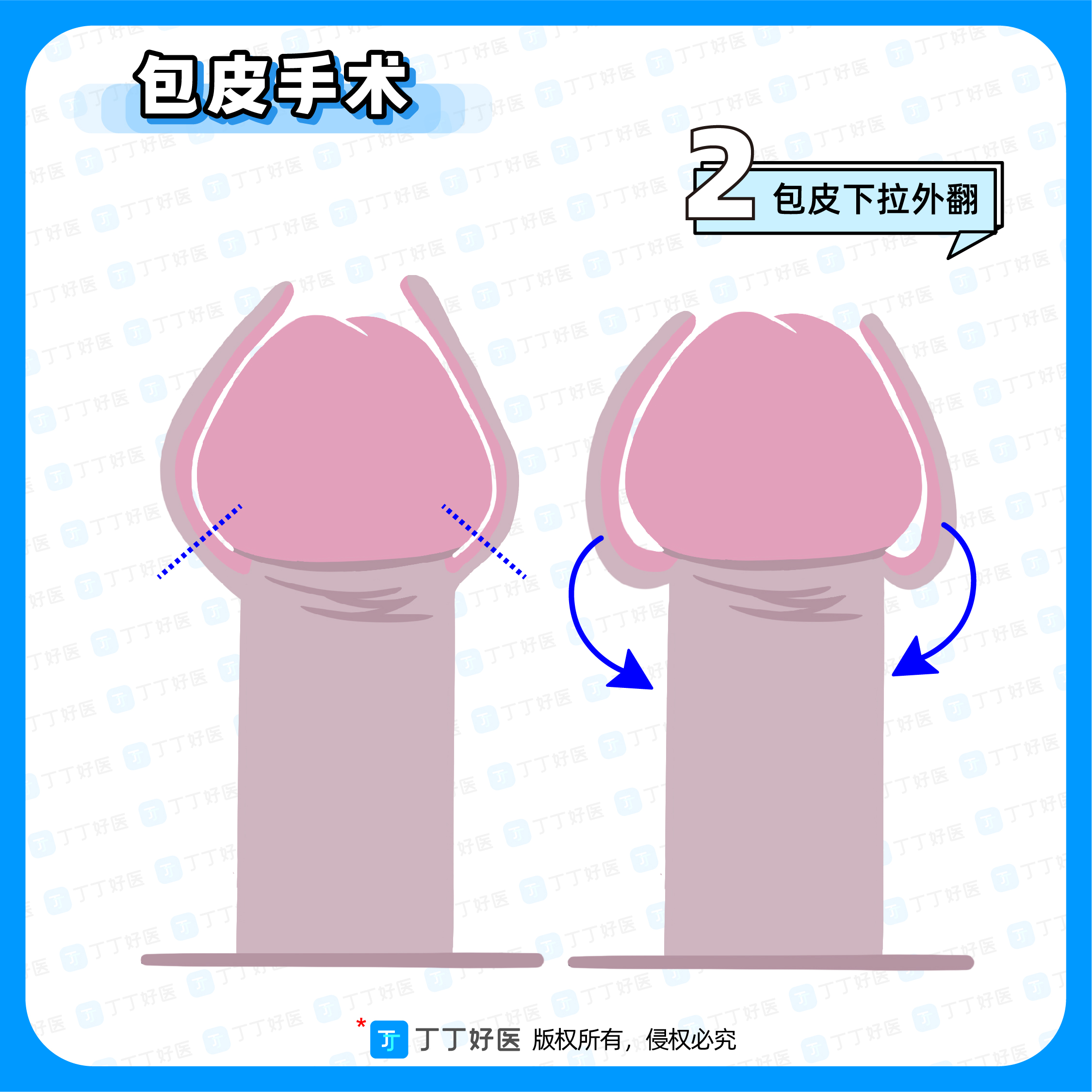 包 茎 勃 起 画 像 - doujin.bar.